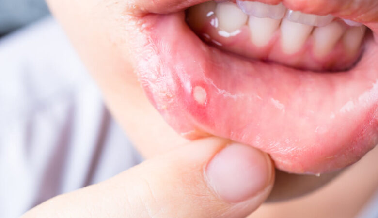 Ulcers - Powerful Natural Remedies Revealed! 5